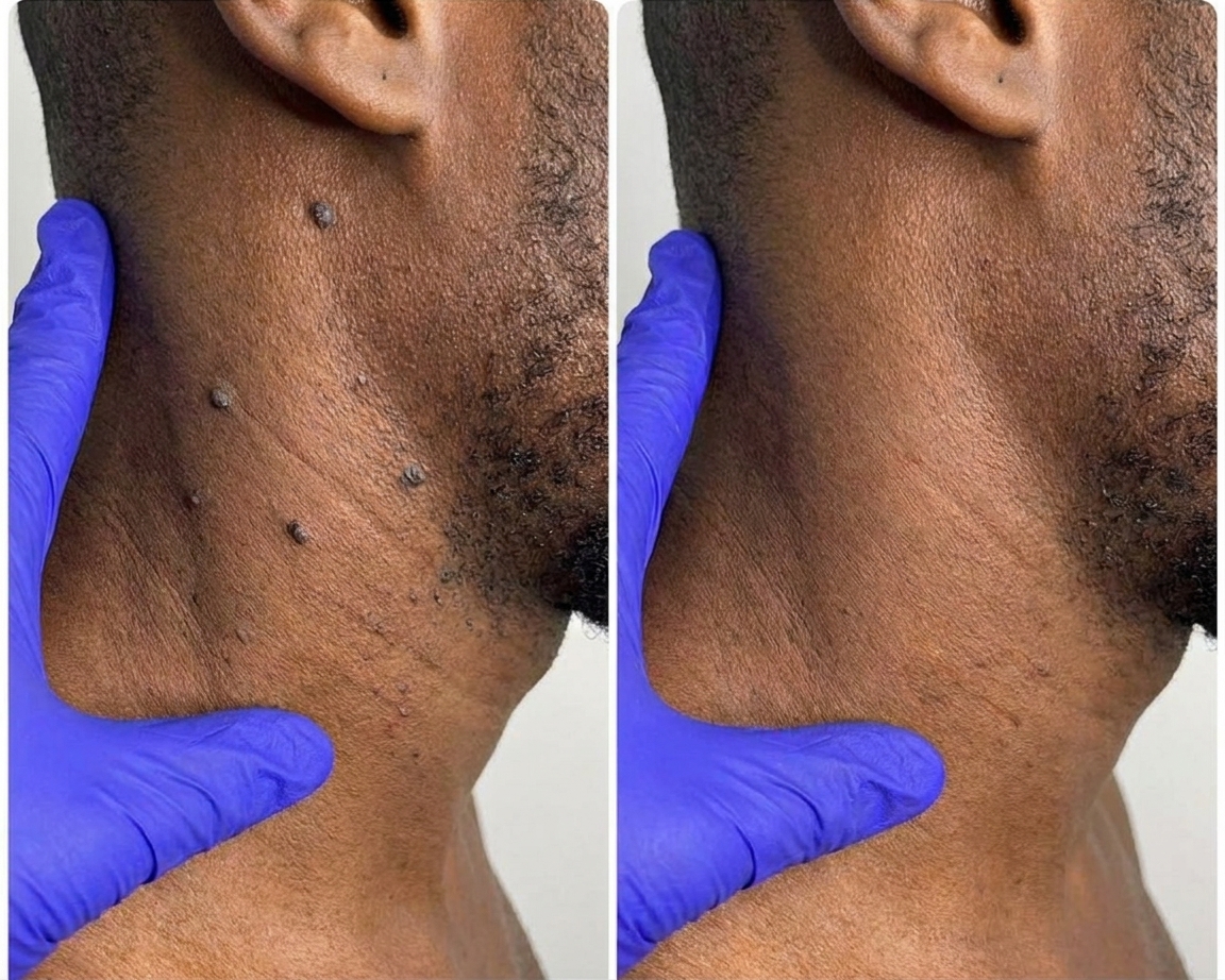 Skin Tag Removal